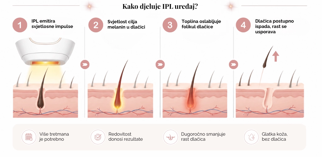 Infografika koja prikazuje kako djeluje IPL uređaj i kako svjetlosni impulsi postupno smanjuju rast dlačica.