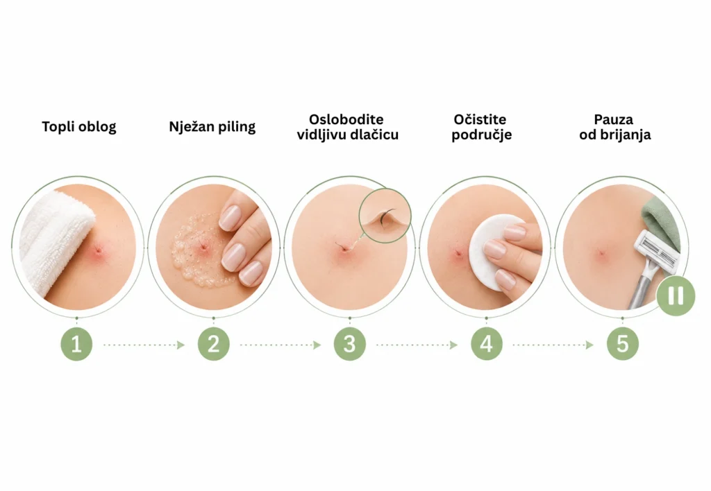 Infografika u 5 koraka za njegu urasle dlake: topli oblog, nježan piling, oslobađanje vidljive dlačice, čišćenje kože i pauza od brijanja.